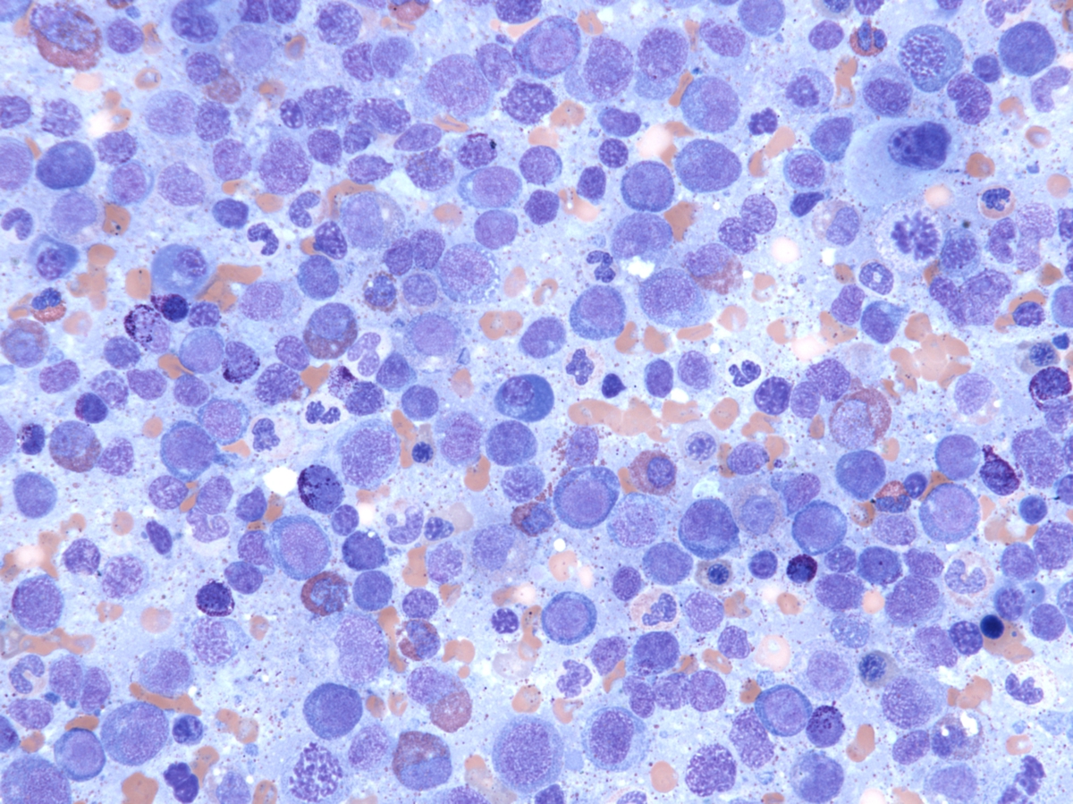 Bone marrow aspirate image #1, Wright-Giemsa, 40x. At the more advanced stage of disease, increased numbers of blasts (29%) and similar multilineage dysplasia present.